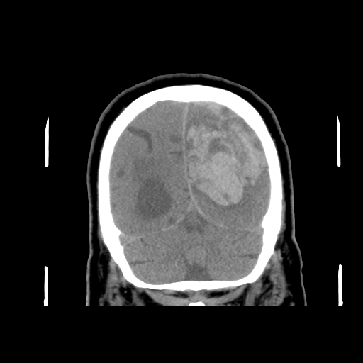 Acute hemorrhagic stroke (Radiopaedia 17507-17223 Coronal non-contrast 45).jpg