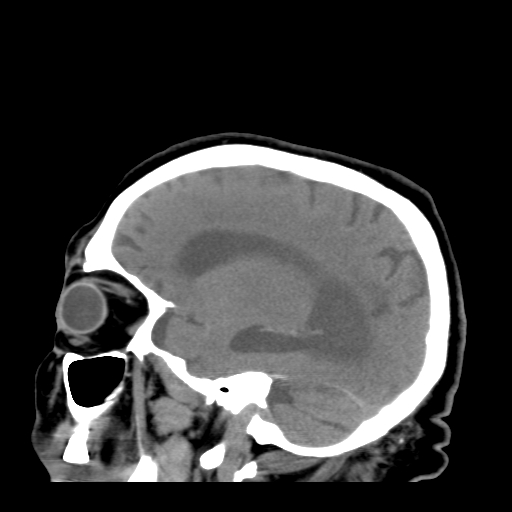 File:Acute hemorrhagic stroke (Radiopaedia 17507-17223 Sagittal non-contrast 33).jpg