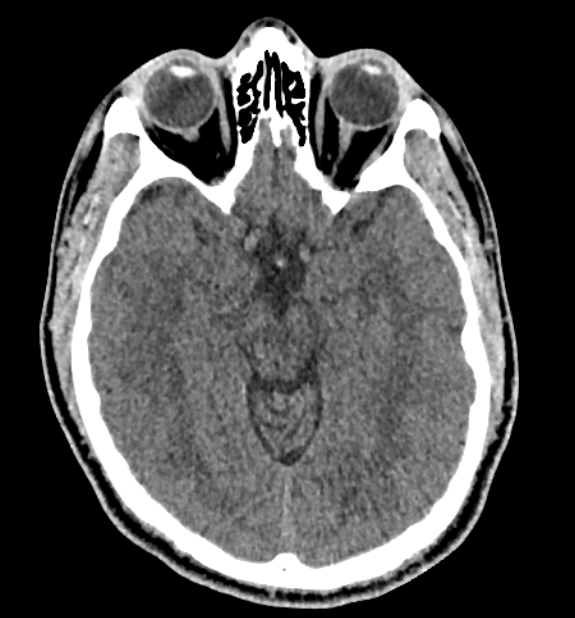 Acute ischemic stroke - posterior circulation territory (Radiopaedia 77670-89881 non-contrast 35).jpg