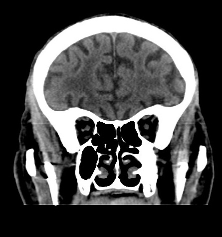 File:Acute left anterior cerebral artery territory infarction (Radiopaedia 51785-57578 Coronal non-contrast 16).jpg