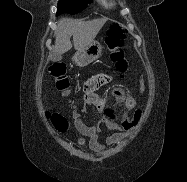 Acute mesenteric ischemia (Radiopaedia 80029-93316 Coronal C+ arterial phase 24).jpg