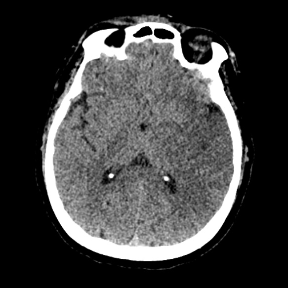 Acute middle cerebral artery territory infarct (Radiopaedia 52380-58283 Axial non-contrast 53).jpg
