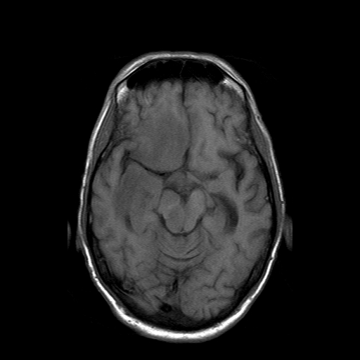 File:Acute necrotizing toxoplasma encephalitis (Radiopaedia 10683-11149 Axial T1 11).jpg