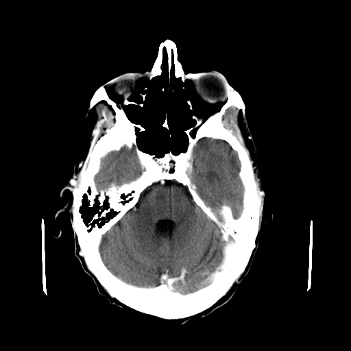 File:Acute necrotizing toxoplasma encephalitis (Radiopaedia 10683-11150 C+ arterial phase 23).jpg
