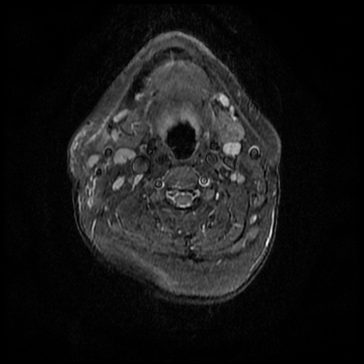 File:Acute otitis externa (Radiopaedia 57296-64236 Axial STIR 20).jpg