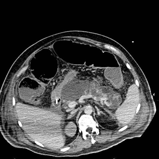 Acute pancreatic necrosis (Radiopaedia 13560-18501 Axial C+ portal venous phase 42).jpg