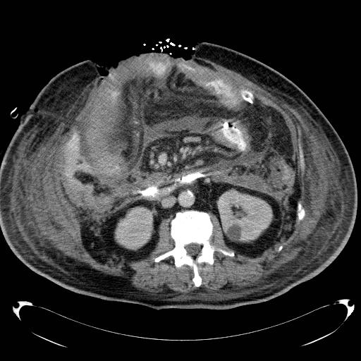 File:Acute pancreatic necrosis (Radiopaedia 13560-18503 Axial C+ portal venous phase 39).jpg