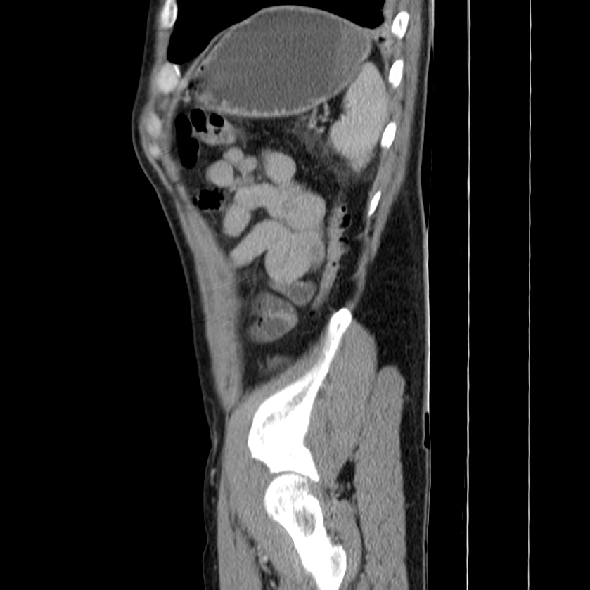 Acute pancreatitis (Radiopaedia 22572-22596 Sagittal C+ portal venous phase 46).jpg
