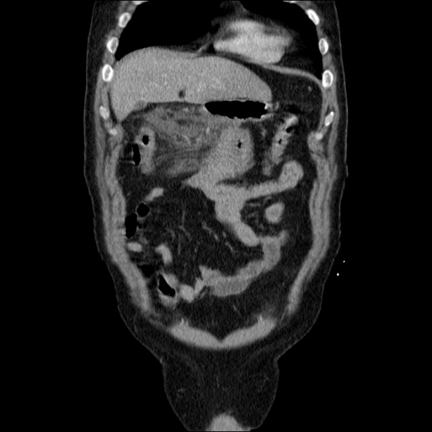 Acute pancreatitis (Radiopaedia 26663-26813 Coronal C+ portal venous phase 16).jpg