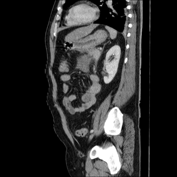 Acute pancreatitis (Radiopaedia 26663-26813 Sagittal C+ portal venous phase 52).jpg