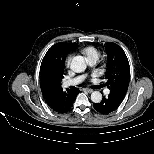 Acute pancreatitis (Radiopaedia 85146-100701 Axial C+ portal venous phase 4).jpg