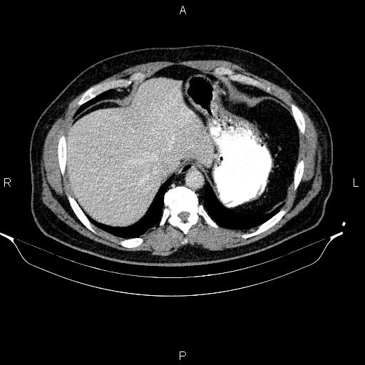 File:Acute pancreatitis (Radiopaedia 85390-101010 Axial C+ portal venous phase 15).jpg