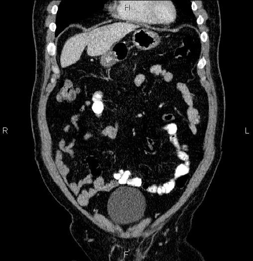 Acute pancreatitis (Radiopaedia 85390-101010 Coronal C+ portal venous phase 15).jpg