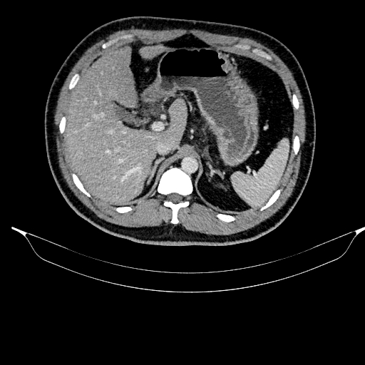Acute pancreatitis (Radiopaedia 87428-103757 Axial C+ portal venous phase 30).jpg