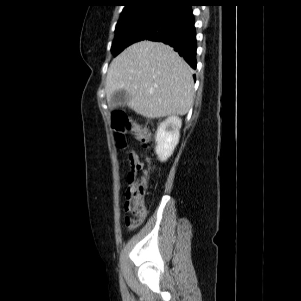 Acute pancreatitis - Balthazar C (Radiopaedia 26569-26714 Sagittal C+ portal venous phase 18).jpg