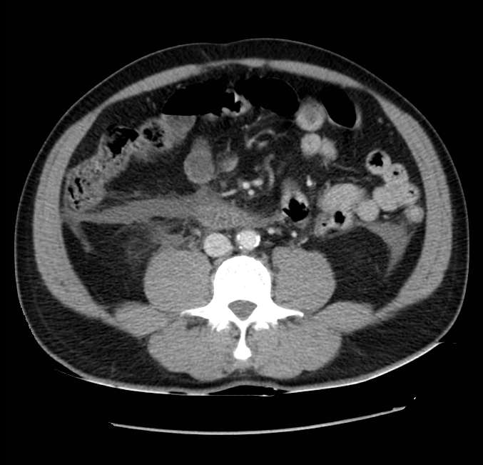 Acute pancreatitis - Balthazar E (Radiopaedia 23080-23110 Axial C+ portal venous phase 40).jpg