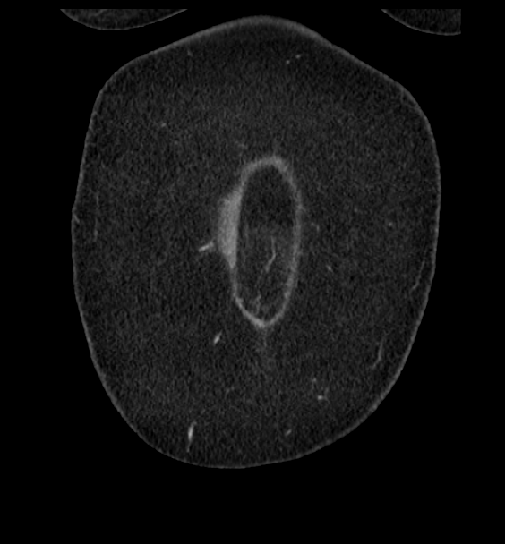 Acute pancreatitis - Balthazar E (Radiopaedia 29016-29377 Coronal C+ portal venous phase 11).png