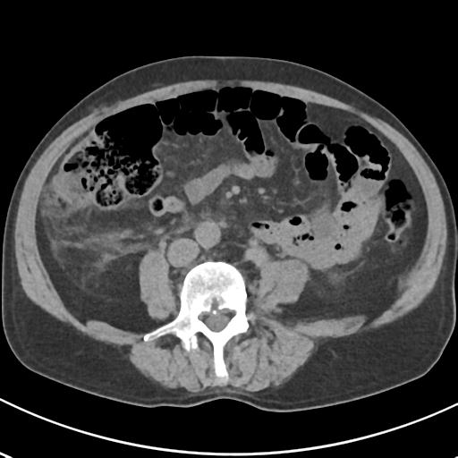 File:Acute pancreatitis and walled-off necrosis (Radiopaedia 29888-30404 Axial non-contrast 47).jpg