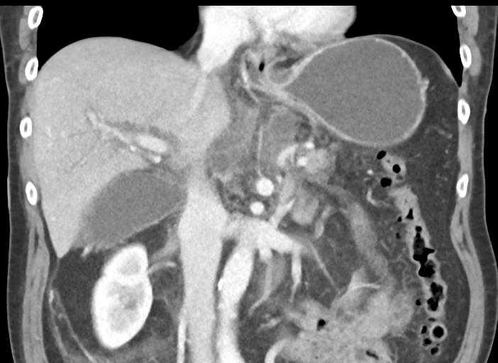 Acute pancreatitis and walled-off necrosis (Radiopaedia 29888-30404 Coronal C+ portal venous phase 28).jpg