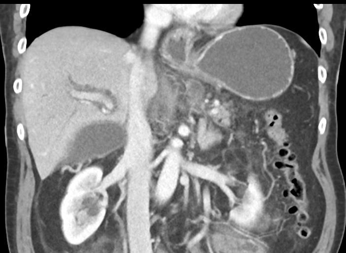 Acute pancreatitis and walled-off necrosis (Radiopaedia 29888-30404 Coronal C+ portal venous phase 29).jpg