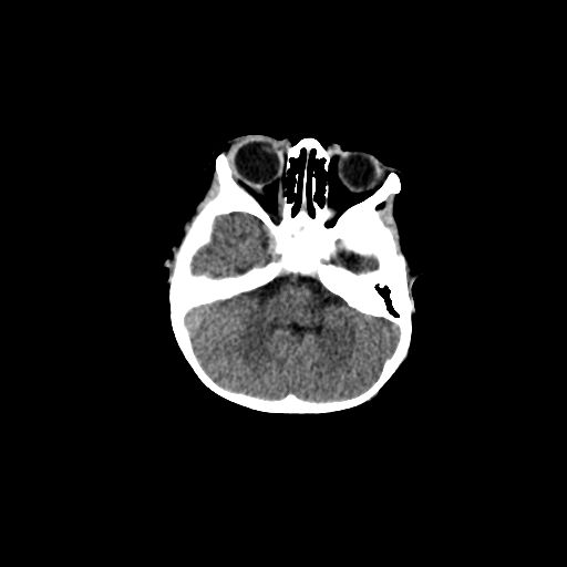 File:Acute phase of hemiconvulsion-hemiplegia epilepsy syndrome (Radiopaedia 29309-29744 Axial non-contrast 41).jpg