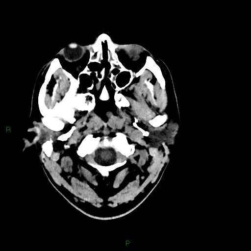 Acute posterior cerebral artery territory infarct (Radiopaedia 79329-92393 Axial non-contrast 8).jpg