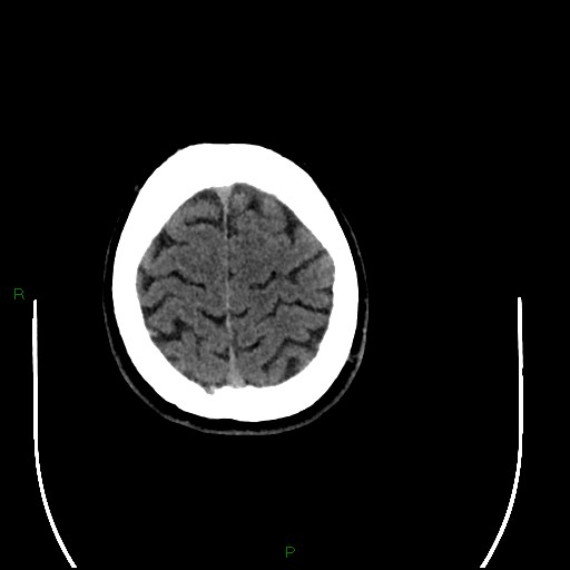 Acute posterior cerebral artery territory infarct (Radiopaedia 79329-92393 Axial non-contrast 98).jpg
