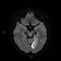Acute posterior cerebral artery territory infarct (Radiopaedia 79329-92394 Axial DWI 12).jpg