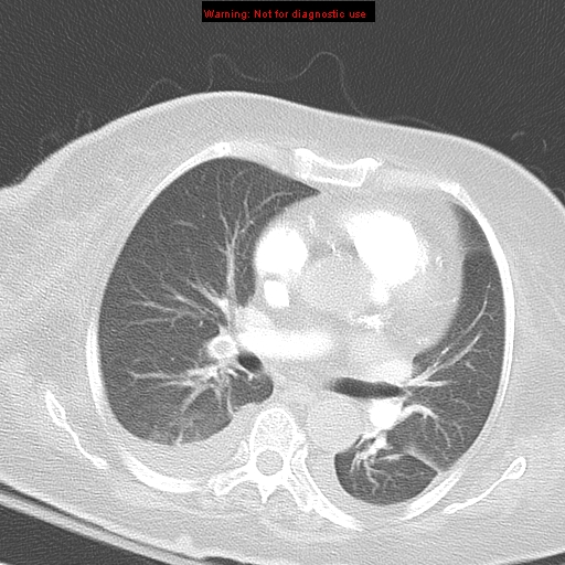 File:Acute pulmonary embolism (Radiopaedia 13286-13289 B 21).jpg