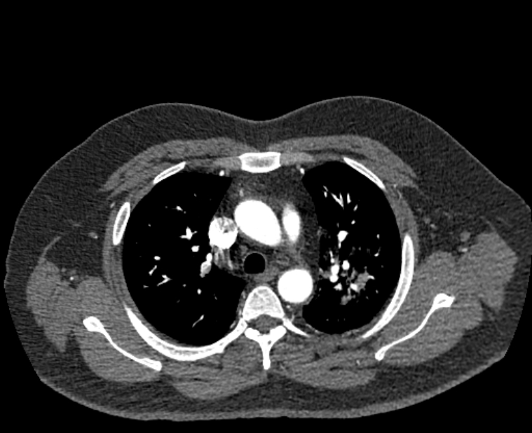 Acute pulmonary embolism with pulmonary infarcts (Radiopaedia 77688-89908 Axial C+ CTPA 18).jpg
