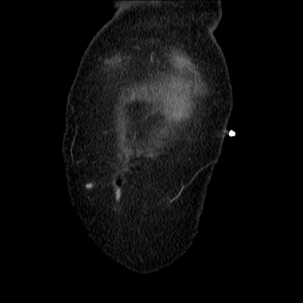 Acute pyelonephritis (Radiopaedia 26584-26729 C+ portal venous phase 7).jpg
