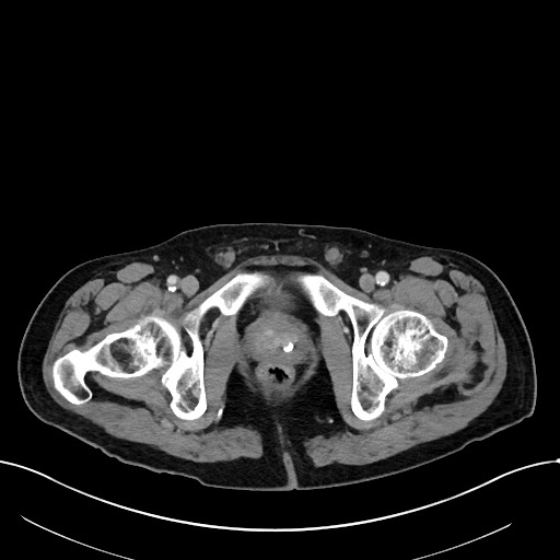 Acute renal infarction (Radiopaedia 59375-66736 Axial C+ portal venous phase 118).jpg