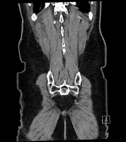 Acute renal infarction (Radiopaedia 59375-66736 Coronal C+ portal venous phase 57).jpg