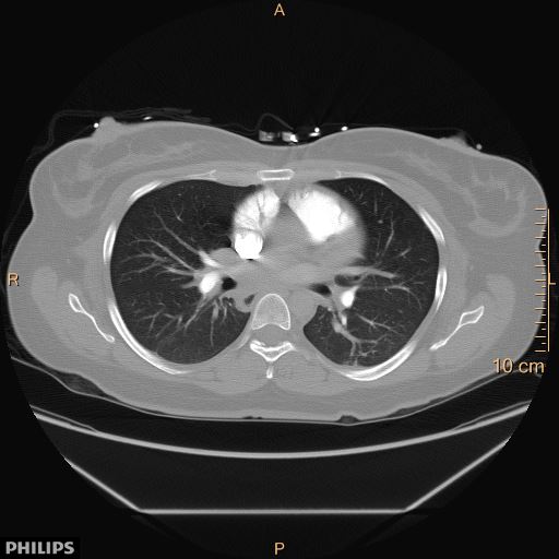 File:Acute reversible pulmonary hypertension and right heart failure from cocaine toxicity (Radiopaedia 49394-54517 Axial 5).jpg