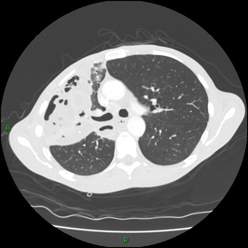 Acute right lung abscess (Radiopaedia 34806-36258 Axial lung window 71).jpg