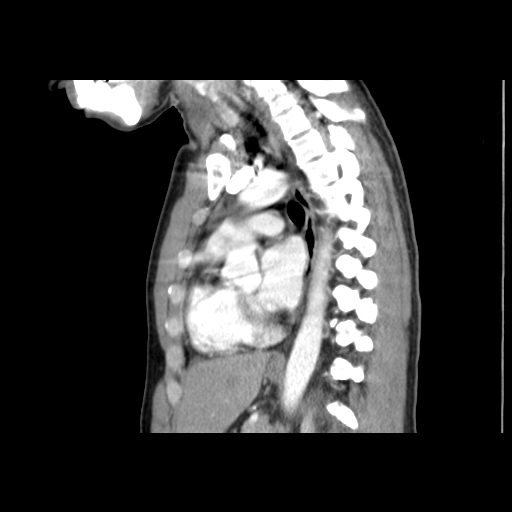 File:Acute segmental pulmonary emboli and pulmonary infarction (Radiopaedia 62264-70444 Sagittal C+ CTPA 38).jpg