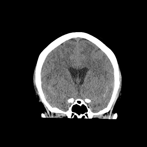 Acute subarachnoid hemorrhage and accessory anterior cerebral artery (Radiopaedia 69231-79008 Coronal non-contrast 32).jpg