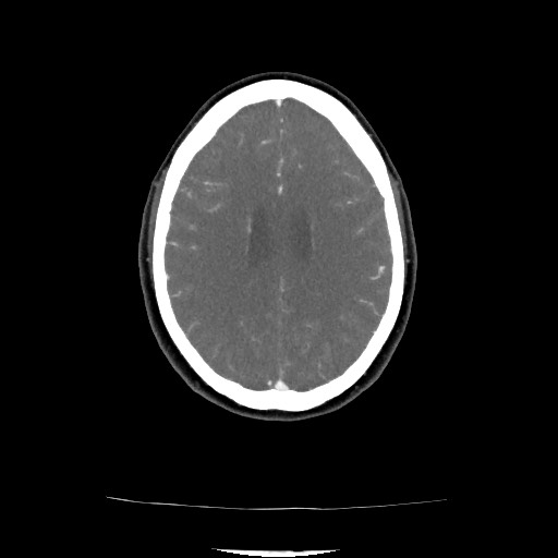 File:Acute subarachnoid hemorrhage and accessory anterior cerebral artery (Radiopaedia 69231-79009 Axial C+ arterial phase 107).jpg