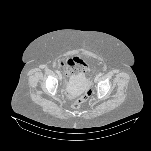 Acute superior mesenteric artery occlusion (Radiopaedia 51288-56960 Axial lung window 69).jpg