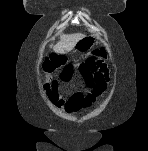 Acute superior mesenteric artery occlusion (Radiopaedia 51288-56960 Coronal C+ portal venous phase 14).jpg
