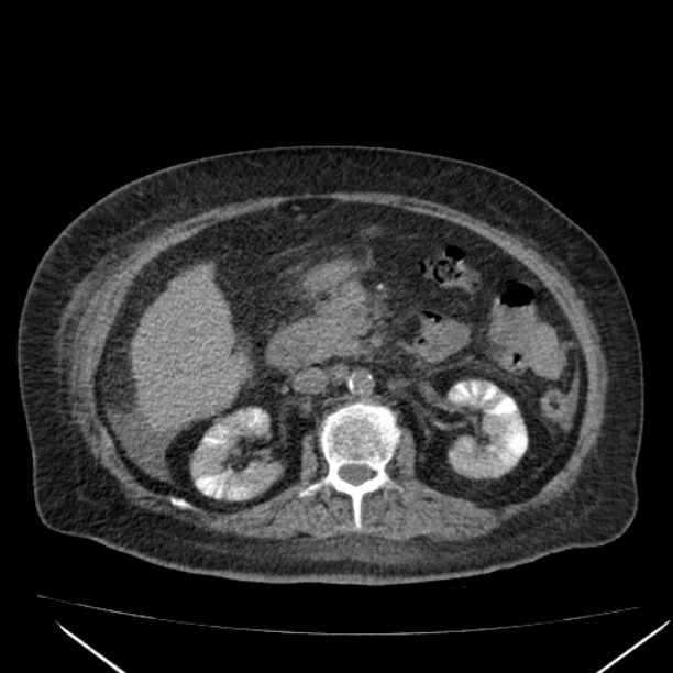 Acute tubular necrosis (Radiopaedia 28077-28334 Axial non-contrast 30).jpg