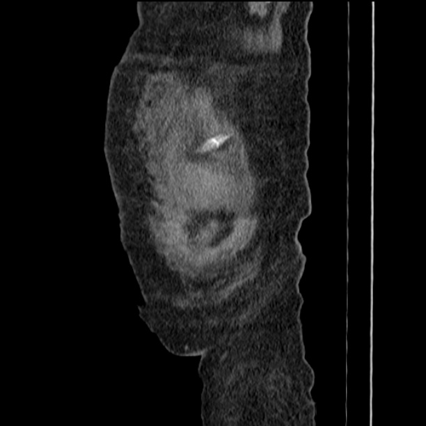 Acute tubular necrosis (Radiopaedia 28077-28334 Sagittal non-contrast 7).jpg