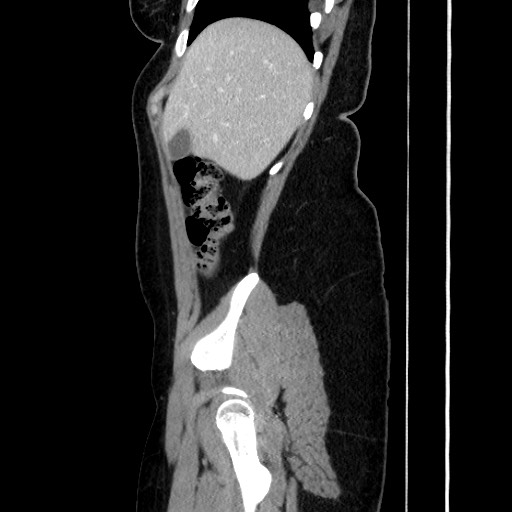 Acute uncomplicated appendicitis (Radiopaedia 73704-84499 Sagittal C+ portal venous phase 62).jpg