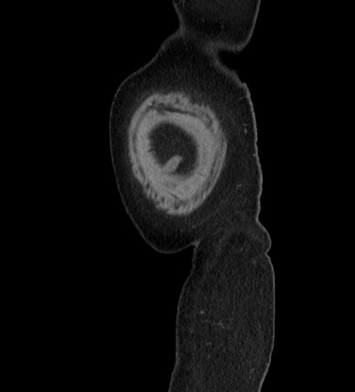 Acute uncomplicated sigmoid diverticulitis (Radiopaedia 82003-95987 Sagittal C+ portal venous phase 2).jpg