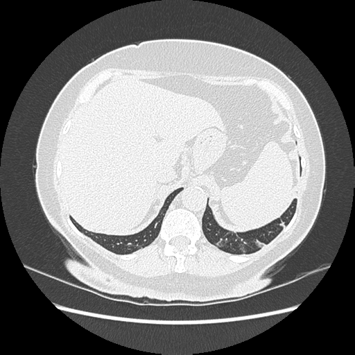 Adenocarcinoma in situ of lung (Radiopaedia 38685-40829 B 201).png