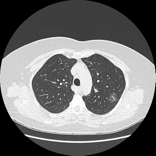 Adenocarcinoma in situ of lung (Radiopaedia 38685-40829 B 65).png