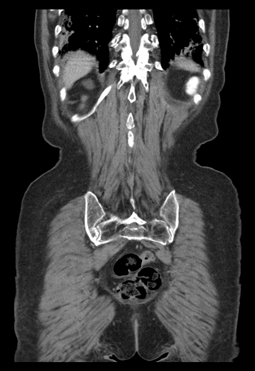 Adenocarcinoma of cecum (Radiopaedia 59222-66549 Coronal C+ portal venous phase 61).jpg