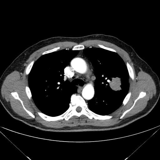 Adenocarcinoma of the lung (Radiopaedia 59871-67325 Axial C+ arterial phase 33).jpg