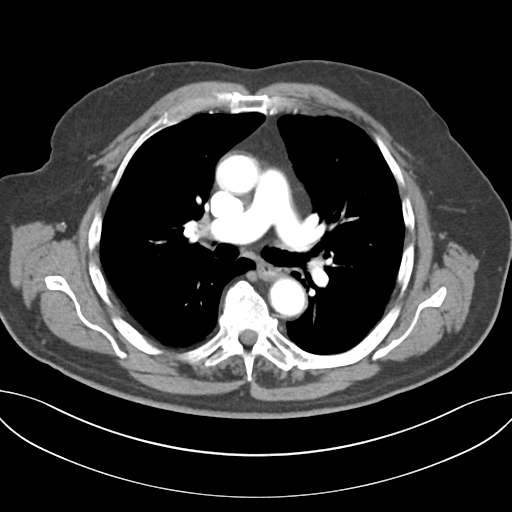 File:Adenocarcioma of rectum- T1 lesion (Radiopaedia 36921-38547 Axial C+ arterial phase 26).png