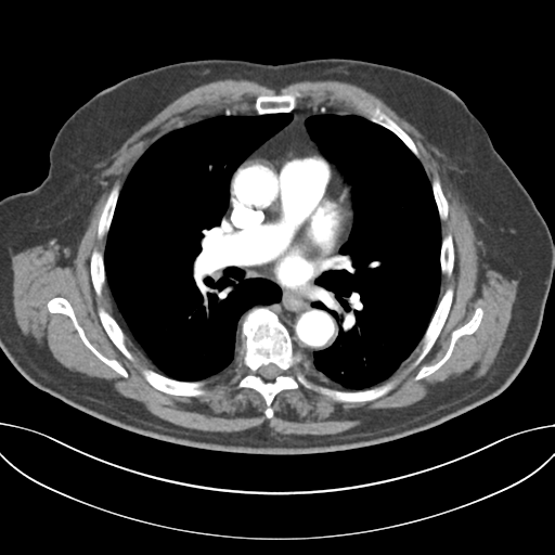 Adenocarcioma of rectum- T1 lesion (Radiopaedia 36921-38547 Axial C+ arterial phase 29).png